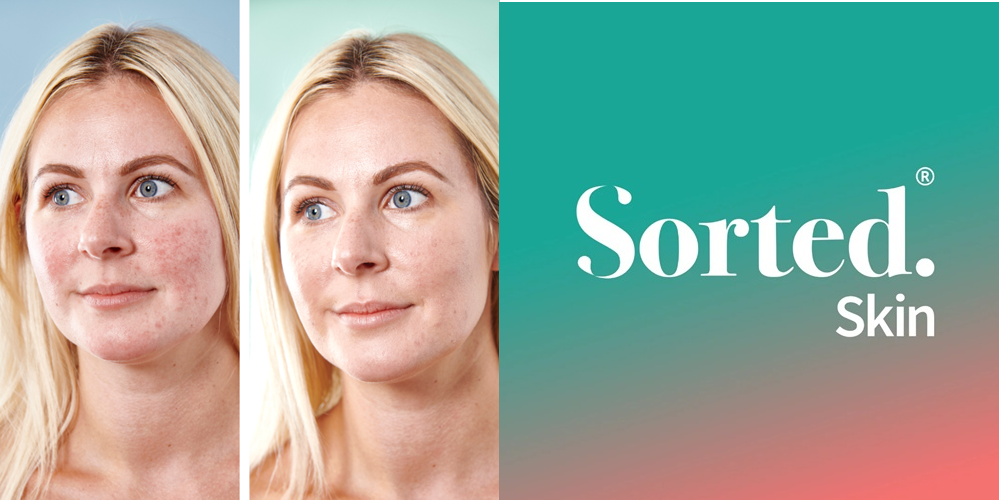 Sorted Skin - Udover at bidrage til hudens sundhed i hverdagen, er Sorted Skin 5-i-1 Anti-Rødhed Dagcreme SPF 50 den perfekte hjælper til dem, der oplever:  Rosacea, couperose, akne, urenheder, rødmen, følsom og irriteret hud, naturlig rød teint, ujævn hudtone, karsprængninger (sprængte kapillærer) og endda solskoldning