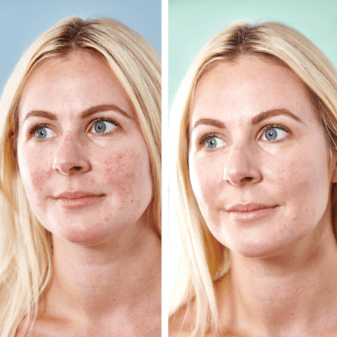 Sorted Skin - 5 in 1 Anti-Redness Day Cream